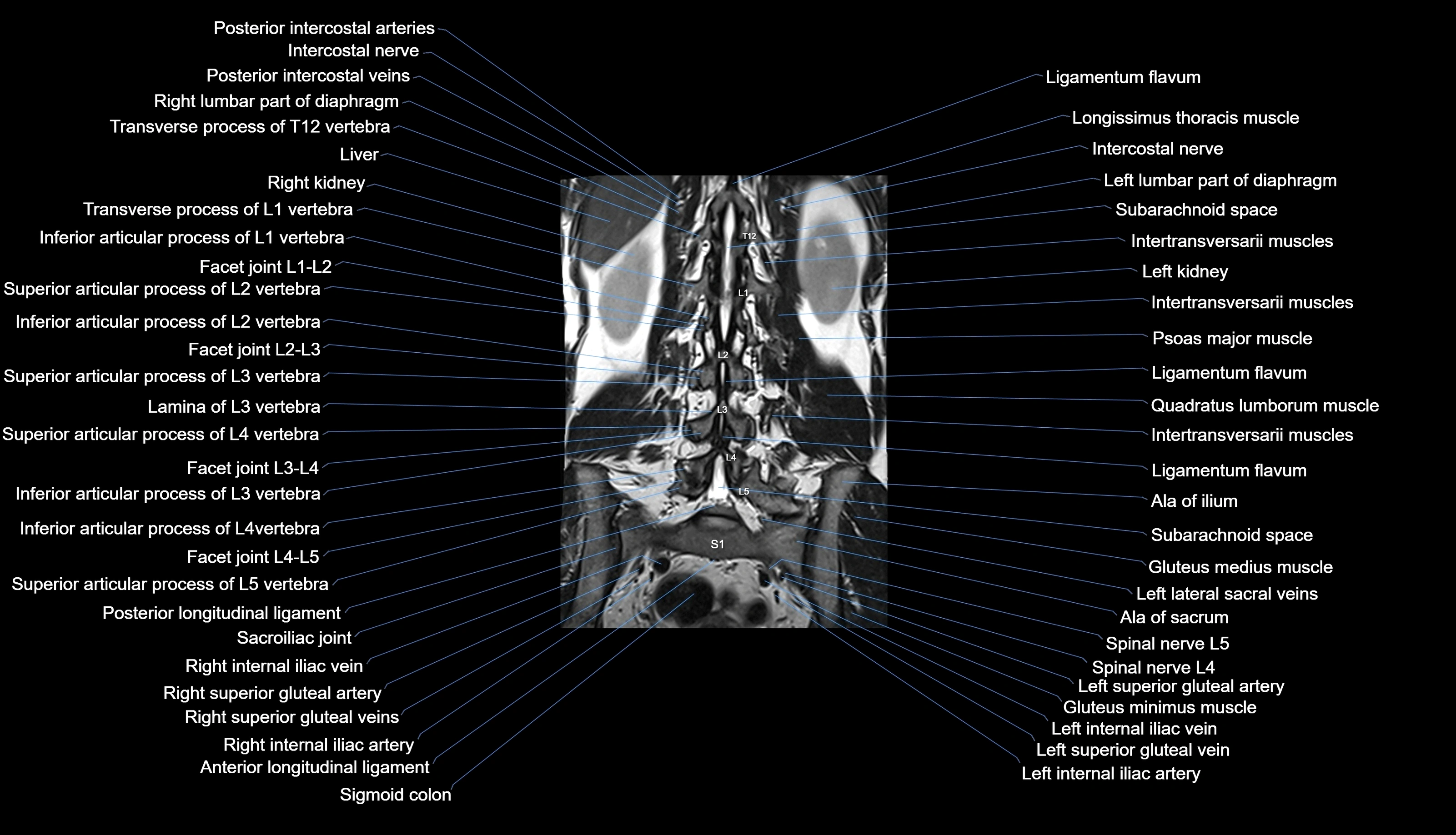MRI lumbar spine labelled coronal cross sectional anatomy 3T radiology-img-00001-00022.webp